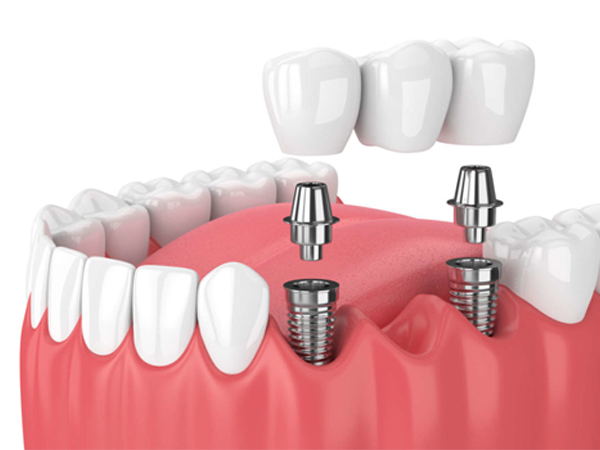 CROWN AND BRIDGE TREATMENT
