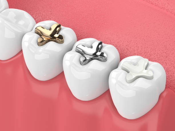 DENTAL FILLINGS