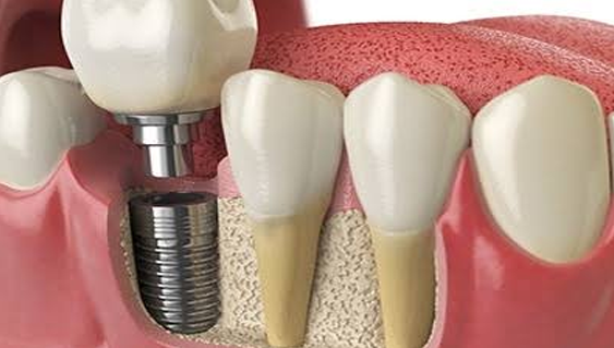 DENTAL IMPLANTS